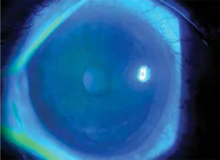 Slit-lamp photograph under cobalt-blue light after fluorescein instillation (from a photokeratitis case). The scattered green spots are areas of corneal epithelial loss. In photokeratitis, the damaged epithelium takes up fluorescein dye, highlighting punctate erosions